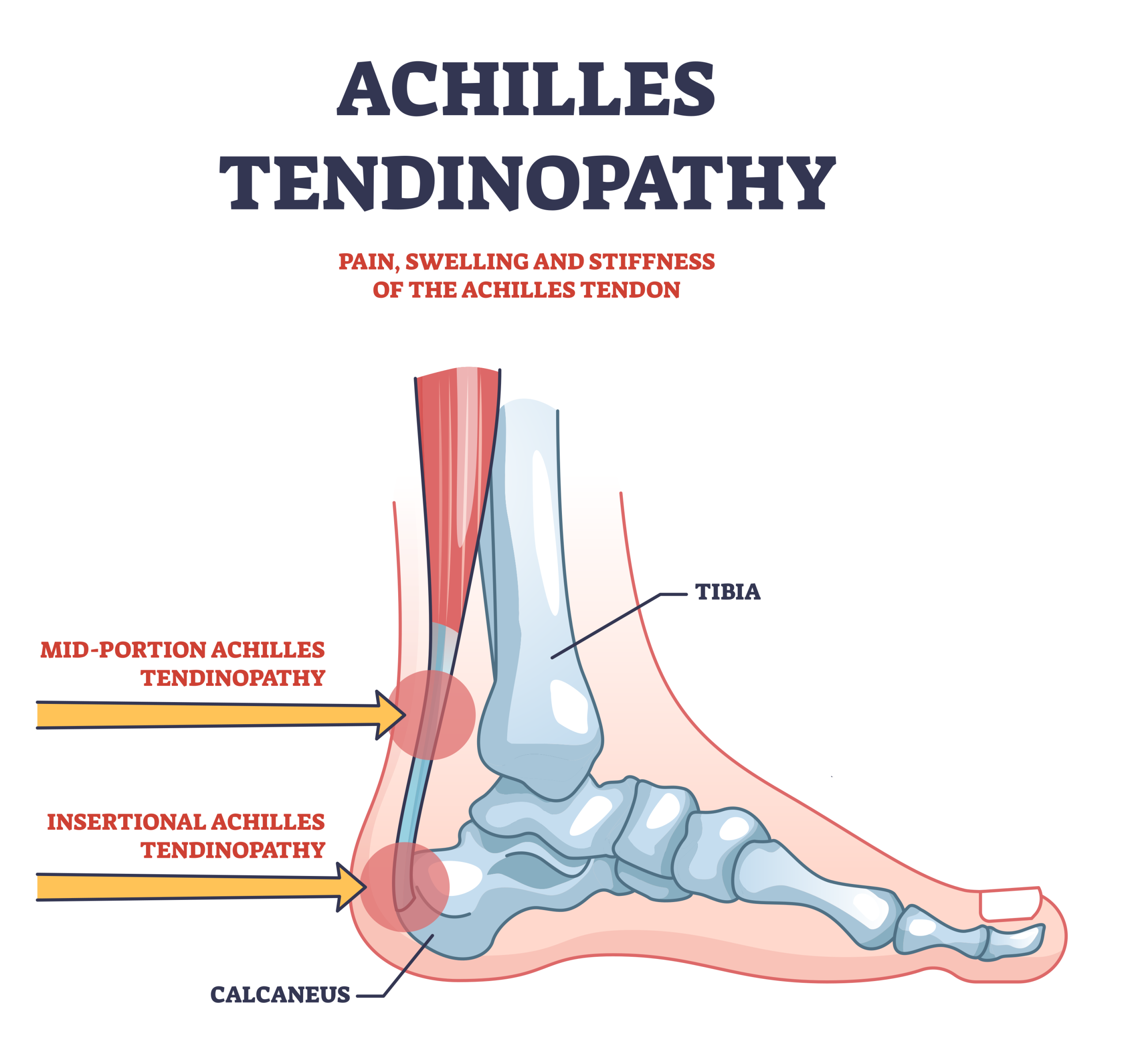 Diagram of Achilles tendinopathy illustrating pain, swelling, and stiffness locations on a side view of a foot and ankle skeleton. Labels highlight mid-portion Achilles tendinopathy near the middle of the tendon and insertional Achilles tendinopathy at the heel bone (calcaneus), with key bones tibia and calcaneus marked in blue.